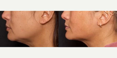 Woman treated with FaceTite - Want to get rid of fat and loose skin without an invasive facelift? FaceTite can give you amazing results. Double board certified facial plastic surgeon, Dr.Vu Ho, uses the latest radio wave technology to tighten the face, neck area when sagging has started. Make that turkey neck go away without surgery.