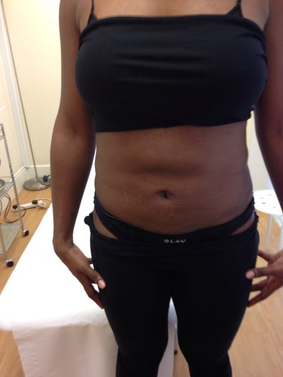 hard lumps belly button lipo surgery rid 10days fibrosis developed ago 5wks had