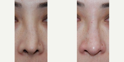 Non-Surgical Rhinoplasty Before & After: Created a Straighter Nasal Appearance with Nostril Lowering and Bump Camouflaging - Our beautiful patient traveled from out of state to see us for our expertise in permanent non-surgical revision rhinoplasty treatments. She had severe dissatisfaction with the appearance of her nose after previous surgery done elsewhere. Her number one concern was her overall crooked nasal appearance. As you can see from her photos, there is a large concavity along her right nasal sidewall. During our consultation, I noted that she had a pinched tip, nostril retraction, visible bone on the bridge of her nose, and a persistent dorsal hump. Her after photos are following a single treatment with microdroplet Silikon-1000 to create a straighter nasal appearance, with nostril lowering, and bump camouflaging, for a less distracting, and less operated nasal appearance. Permanent non-surgical revision rhinoplasty treatments like this have more than 60 years of precision, permanence, and safety. And unlike temporary gel fillers, like HA, microdroplet Silikon-1000 treatments are never associated with necrosis, embolus, blindness, stroke, infection, or biofilm. When we meet someone who is a good candidate for a permanent non-surgical revision rhinoplasty, these are often some of the happiest patients in our practice, when they see their final result. If you want to see if you would be a good candidate for this, we offer free digital consultations, here, on our website.