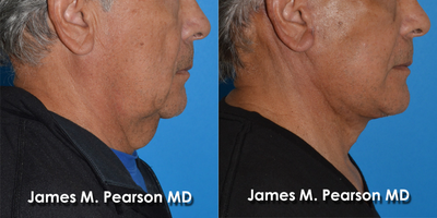 65-74 year old man treated with Facelift - 65-74 year old man treated with Facelift and Neck Lift