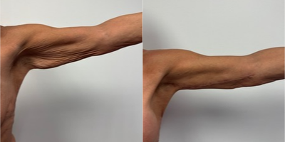 55-64 year old woman treated with Arm Lift - 9 weeks after an arm lift