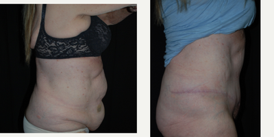 65-74 year old woman treated with Tummy Tuck - HCG Diet with Abdominoplasty