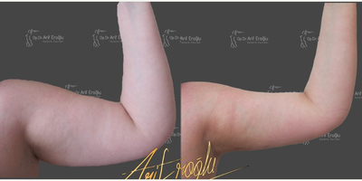 Woman treated with Arm Lift, Vaser Liposuction, Renuvion - Arms Vaserlipo and Helium Gas Plasma (J Plasma) Postop 5 months laterArms are an important area in the overall beauty of the female body.Problems such as fat and skin laxity in the arms can be problematic and cause a great deal of anxiety, especially when wearing dresses.Procedures such as 3D Laser Lipolysis and Renuvion J Plasma help you get more elegant looking arms