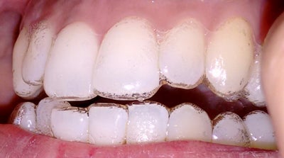 gapped teeth invisalign