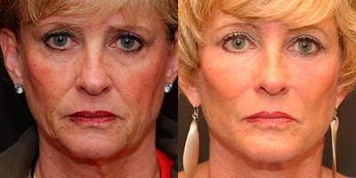 Woman treated with Laser Resurfacing - Facial Resurfacing