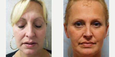 35-44 year old woman treated with Rhinoplasty - She desires improvement of the slight dorsal convexity and mild tip droop. Spreader grafting, shaving of the dorsal hump, tip suturing with rotation, and concomitant osteotomy result in a more feminine tip; post-op she was ecstatic.
