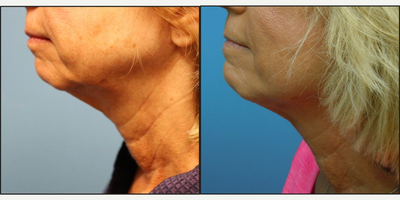 55-64 year old woman treated with Skin Tightening - This 56 year old patient came in for Profound looking to tighten the neck and lower face skin.