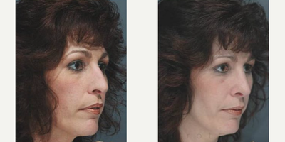 Woman treated with Rhinoplasty - This patient had a Rhinoplasty by Dr. Marotta.