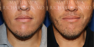 35-44 year old man treated with Beard Transplant - Beard transplant for male patient, 6 months post-op. Approximately 1800 grafts were placed.