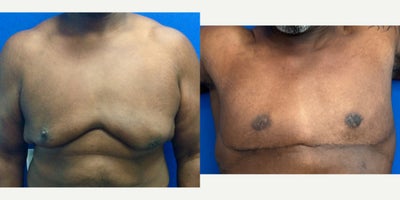 55-64 year old man treated with Breast Reduction, Nipple Surgery, Liposuction - 57yo male who underwent Gynecomastia surgery with free nipple graft