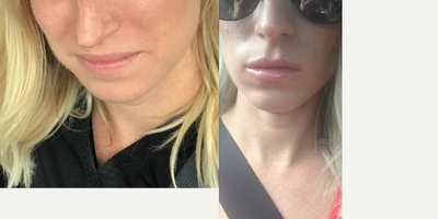 25-34 year old woman treated with Volbella - 33 year old concerned with lack of fullness in the lips. Volbella was injected to the area.