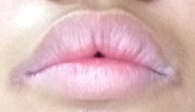 How can I treat the black spots on the corners of my lips ...