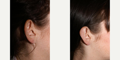 Woman treated with Ear Surgery - Woman treated with Ear Surgery.