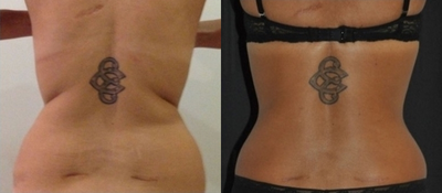 Vaser Liposuction - This patient received upper and lower back treatment using Vaser Liposculpture.