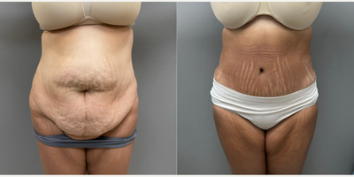 Woman treated with Tummy Tuck - Tummy Tuck