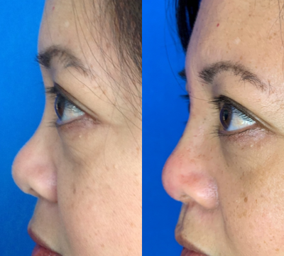 45-54 year old woman treated with Nonsurgical Nose Job - Patient had bump in nose that bothered her. With threads, the doctor was able to smooth and make nose look narrower. Patient's before and after photos are the same day of treatment.