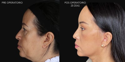 Facial Lift Results with Just 28 Days of Recovery - Our patient underwent a full facelift: In the upper third, video endoscopy was performed.In the middle third, a High SMAS vertical lift was performed.The eyelid region was treated by removing a minimal amount of fat from the bags through the conjunctiva (transconjunctival blepharoplasty).On the neck, we performed a cervicoplasty: we removed fat and pulled the neck muscle backward (Platysma).We also performed fat injections in the cheeks, lips, and chin.Despite the firm and toned appearance, the amount of skin removed was minimal.Modern facelift techniques focus on repositioning deep fibro-adipose structures, repositioning and tightening the facial musculature, restoring volume with the patients own fat, and performing a redrapethat is, reattaching the skin with minimal tension.The patient is currently on day 28 post-surgery.