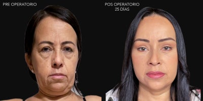 Facial Lift Results with Just 28 Days of Recovery - Our patient underwent a full facelift: In the upper third, video endoscopy was performed.In the middle third, a High SMAS vertical lift was performed.The eyelid region was treated by removing a minimal amount of fat from the bags through the conjunctiva (transconjunctival blepharoplasty).On the neck, we performed a cervicoplasty: we removed fat and pulled the neck muscle backward (Platysma).We also performed fat injections in the cheeks, lips, and chin.Despite the firm and toned appearance, the amount of skin removed was minimal.Modern facelift techniques focus on repositioning deep fibro-adipose structures, repositioning and tightening the facial musculature, restoring volume with the patients own fat, and performing a redrapethat is, reattaching the skin with minimal tension.The patient is currently on day 28 post-surgery.