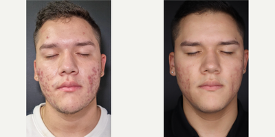 18-24 year old man treated with Scar Removal, CO2 Laser, Fraxel Laser, Microneedling RF, Chemical Peel, HydraFacial - This patient underwent a combination treatment in which we used in his first stage Hydrafacial and chemical peel with Acnelan peel, and later on one session of CO2 fractional laser and microoneedle RF