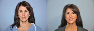 Face & Eyelid Lift - This 50 year old mother of one came to us to discuss a mini facelift and upper and lower eyelid lift. Examination showed her to be a good candidate for an anterior or mini facelift, tightening up the jawline and mid-face in a very soft, natural way. The same was true for the upper and lower eyelid lifts as the patient had some excess skin on both. 