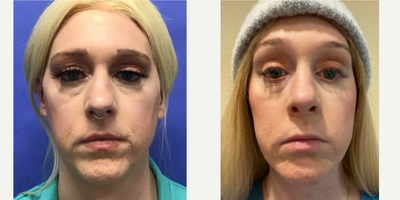 Patient treated with Cheek Augmentation, Facelift, Facial Feminization Surgery, Lower Facelift, Neck Lift, Rhinoplasty, Septopla - 35 to 44 year-old female patient is 6 months post-op from Facial Feminization surgery. Her procedures included: Revision Forehead Lift and Orbital Bony Contouring, Septorhinoplasty with Cartilage Grafts and Weirs, Cheek Implants (small), Pre-Jowl Implant with Chin Reduction and Contour, Intranasal Lip Lift with Fat Augmentation, Thyroid Cartilage Shave and Voice Feminization, Revision Lower Eyelid Blepharoplasty (TC) with Fat Reposition and Fat Removal, Facelift/Necklift with Soft Tissue to Nasolabial Folds, TCA Peel - Lower Lids and Juvederm - Perioral 1cc.