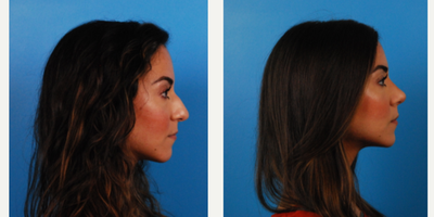 25-34 year old woman treated with Rhinoplasty - This patient had a rhinoplasty to improve her bulbous tip and dorsal hump. She desired an overall smaller nose.