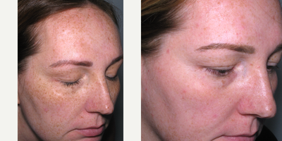 35-44 year old woman treated with Skin Rejuvenation - This patient was treated with the Obagi Nuderm system. The after photos show results after 4 weeks.
