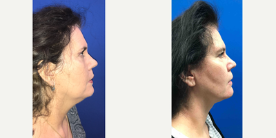 55-64 year old woman treated with Chin Surgery - Neck and jawline sculpting with local anesthesia and a quick recovery.