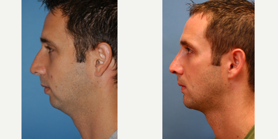 25-34 year old man treated with Chin Implant - This patient had refinement of the nose along with augmentation of the chin.