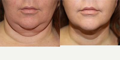 45-54 year old woman treated with Liposuction - Neck and jawline liposuction