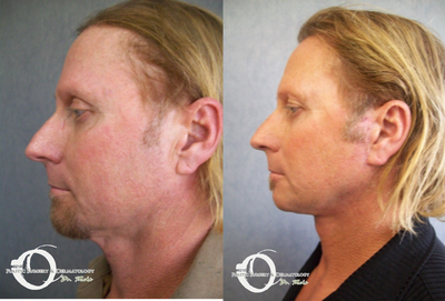 45-54 year old man treated with Lower Face Lift - Full face and neck lift