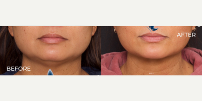 Woman treated with Facelift - Woman treated with Facelift