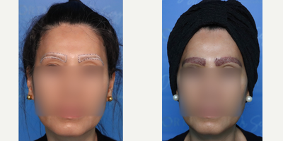 35-44 year old woman treated with Eyebrow Transplant - This lady wanted to have full eyebrow restoration.For each brow approx.:1- 220 single grafts2- 50 double grafts (placed in the central body of each brow to give a denser look)