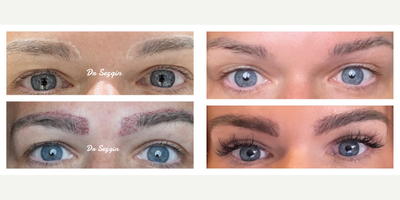 45-54 year old woman treated with Eyebrow Transplant - This lady wanted to have eyebrow-head restoration and increase the thickness of body and tail