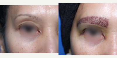 35-44 year old woman treated with Eyebrow Transplant - This lady wanted to have full eyebrow restoration.For each brow approx.:1- 220 single grafts2- 50 double grafts (placed in the central body of each brow to give a denser look)