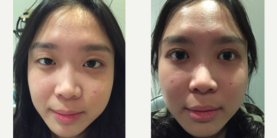 18-24 year old woman treated with Double Eyelid Surgery - 21 year old Asian female patient underwent double eyelid surgery to create symmetric and natural upper lid creases. She also had some asymmetry of the lid height (lid ptosis) which we corrected at the same time.