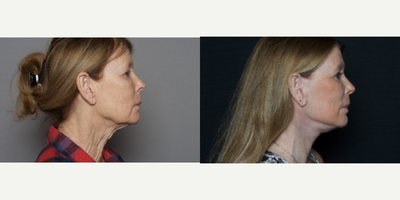 65-74 year old woman treated with Facelift - 65-74 year old woman treated with Facelift