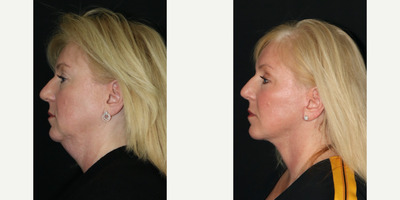Woman treated with Facelift - This patient wanted to look more refreshed and youthful. I performed a facelift, neck lift and facial fat transfer to help her achieve a more defined jawline and neck without looking pulled or stretched. She is 3 months postop. Her procedures were performed without general anesthesia. (Facelift , Neck Lift, Fat Transfer)
