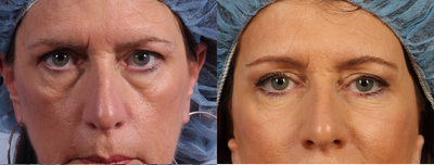 55-64 year old woman treated with Eyelid Surgery - Lower eyelid lift with fat grafting