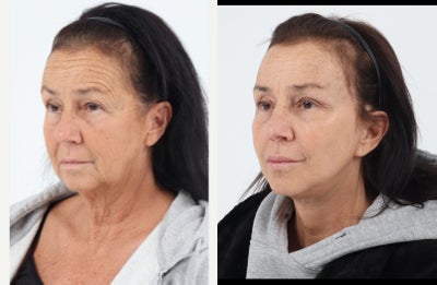65-74 year old woman treated with Brow Lift, Eyelid Surgery, Facelift, Neck Lift, Facial Fat Transfer, Laser Resurfacing - Patient in her 60's 2month after a Facelift, Neck lift, Facial Fat Transfer, Temporal Brow Lift, Upper Eyelid Blepharoplasty and co2 laser.