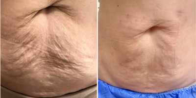 45-54 year old woman treated with Thread Lift - Minimally invasive non-surgical stomach rejuvenation with PDO threads. Performed under local anesthesia. Results shown are just 1 month apart! :) Results are expected to improve over the next couple of months due to the collagen stimulation.