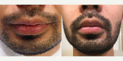 Beard Transplant - Woman treated with Beard Transplant