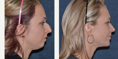 25-34 year old woman treated with Chin Implant - Patient who had primary Rhinoplasty and Chin augmentation to balance facial proportions.