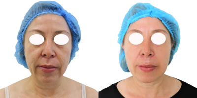 45-54 year old woman treated with Ultherapy - This is a treatment with microfocused ultrasound technology and visualization. Helps achieve a fresher, more youthful look from the eyebrows to the cleavage. Improves skin appearance. Generates skin retraction. Optimize collagen production. Improves tone and texture. Oxygenates and provides hydration to the treated areas.