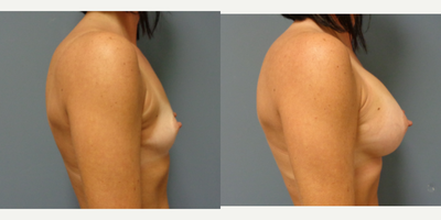 35-44 year old woman treated with Mentor Breast Implants - 36 year old female treated with Breast Augmentation using 350 cc implants by Mentor