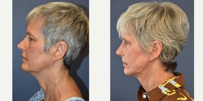 Woman treated with Facelift, Neck Lift - Woman treated with Facelift, Neck Lift