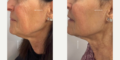 Woman treated with Sylfirm X - After our clients FIRST Sylfirm treatment, she is already seeing a significant difference in the appearance of her skin.Sylfirm X is a Radio Frequency Microneedling treatment. This device has non-insulated needles that emit radio frequency energy evenly to each layer of the skin.By penetrating to the accurate target depth, we can induce optimal results with extra effectiveness.