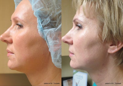 Ultherapy neck lift - Utherapy of the neck - non invasive neck lit