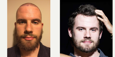 25-34 year old man treated with Hair Loss Treatment - Patient transplanted 1000 grafts in the hairline & top; 10 months post op. Pt also began a medical therapy at the time of procedure