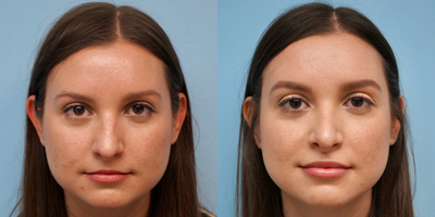 25-34 year old woman treated with Rhinoplasty - Open rhinoplasty and lip filler
